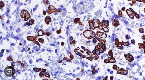 Muestras de patología