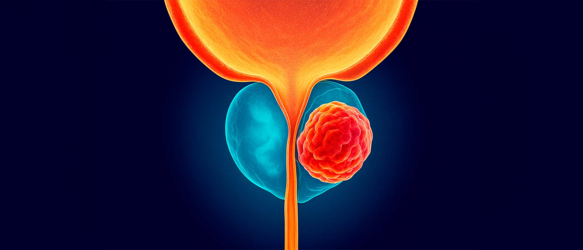 Representación de un sistema urinario con tumor prostático.