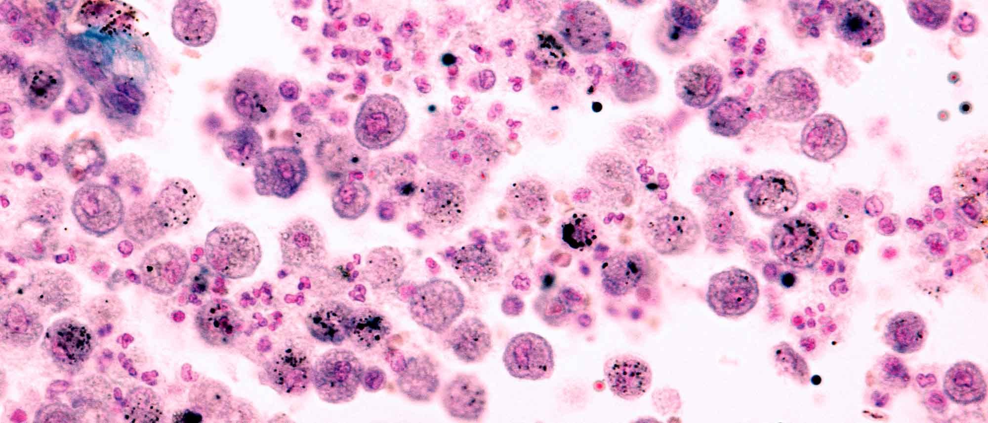 vista microscópica de una citología de una citología de orina.