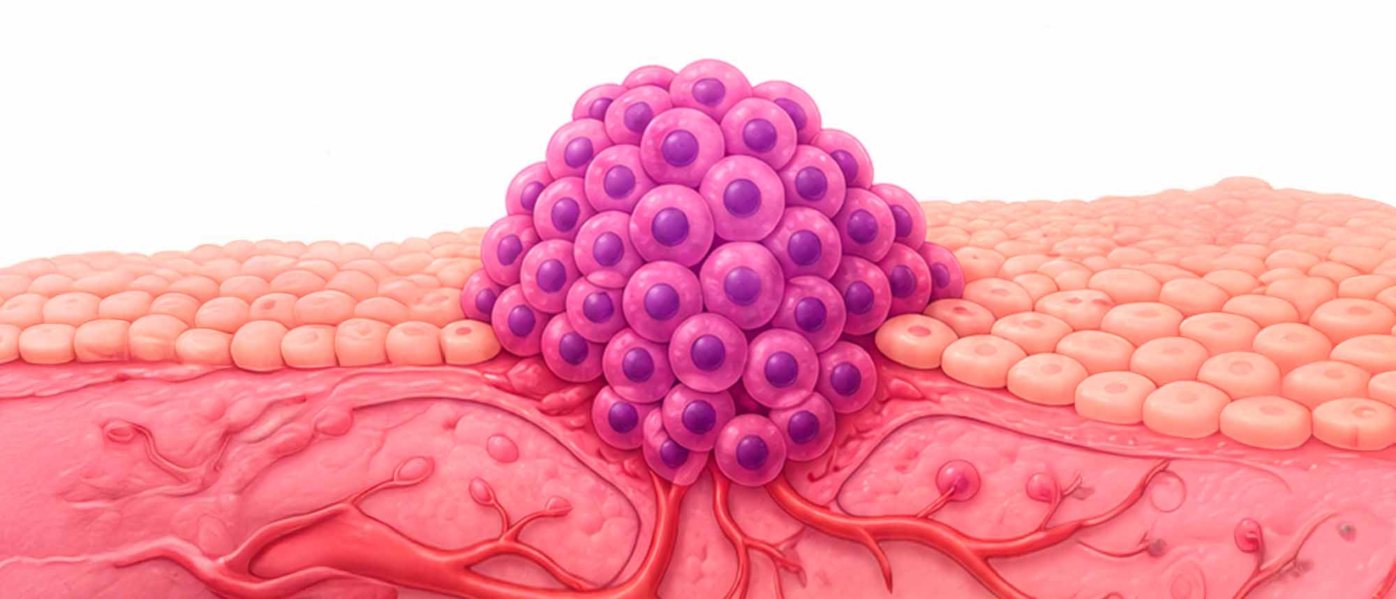 Tumor, formado por un crecimiento anormal de células de forma descontrolada.